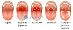 Длительный фарингит, кандидоз в полости рта