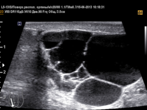 Узи органов мошонки: анэхогенные образования