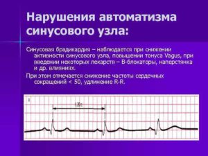 Нарушение сердечного ритма неуточненное(149,9) Дисфункция синусового узла, синусовая брадиаритмия ва