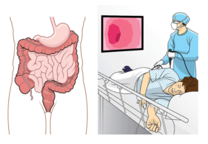 Чем могут заразить при колоноскопии