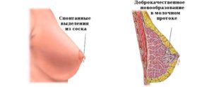 Выделение крови из соска груди при его надавливании