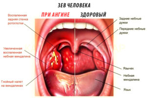 Что-то мешает в горле, ком в горле