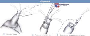 Можно ли обработать зеленку писюн после обрезания