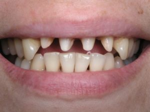 Ужасное состояние зубов, кариес на передних зубах, протезирование нужно