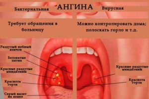 Что с горлом? Горло не болит температуры нет