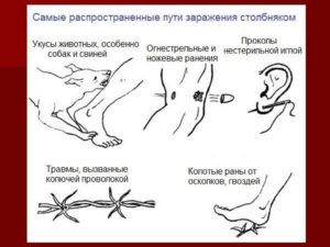 Вероятность заражения столбняком