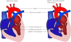 Дефект межпредсердной перегородки у новорожденного