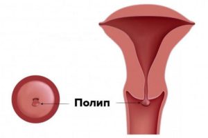 Децидуальный полип и обильные кровотечения при беременности