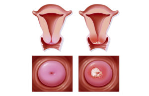 Эрозия шейки матки