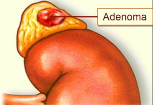 Что делать если обнаружили аденому надпочечника