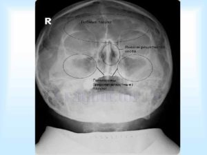 Вросшая ячейка решётчатой кости правой лобной пазухи