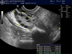 Возможно ли забеременеть при таких показателях узи