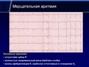 Мерцательная аритмия не лечится