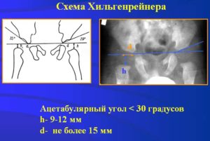 В норме ли ацетабулярные индексы