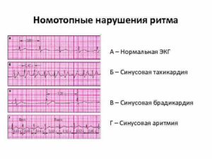 Нарушение сердечного ритма неуточненное(149,9) Дисфункция синусового узла, синусовая брадиаритмия ва