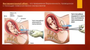 Можно ли делать аборт при температуре?