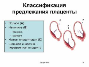 Краевое предлежание плаценты на 23 неделе