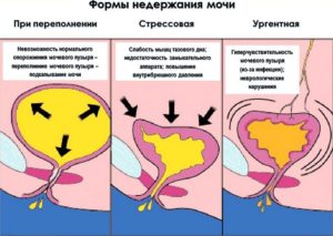 Мочеиспускание при смехе