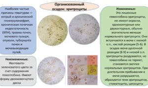 Высокая температура и эритроциты в моче