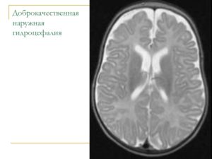 МР картина умеренно выраженной наружной гидроцефалии и точечная боль справа