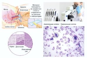 ВПЧ и онкоцитология