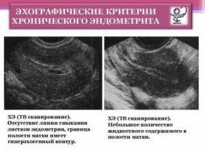 Эндометрия, полость матки контур неровный