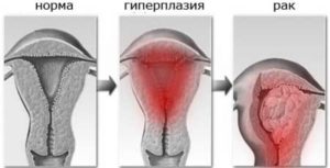 Дипроспан, гиперплазия эндометрия