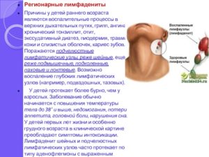 Длительное увеличение тонзиллярных узлов у ребенка