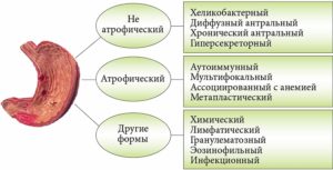 Что принимать при гэрб, имея атрофический гастрит