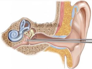 Восстановления слуха после тимпанопластики