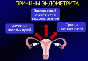 Можно ли заниматься сексом при лечении эндометрита