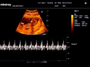 Эмбрион увеличивается в размерах, а сердцебиения нет