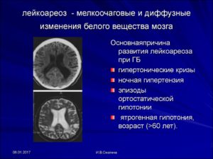 Мелкоочаговые поражения белого вещества головного мозга