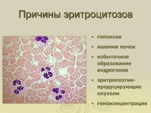 Эритроцитоз + микроцитоз - в чем причина?