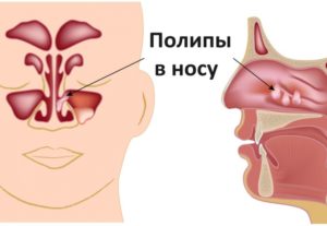 В носу что то мешает