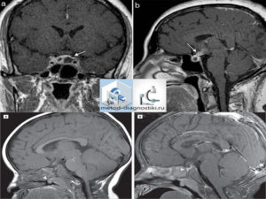 Мрт гипофиза без контраста