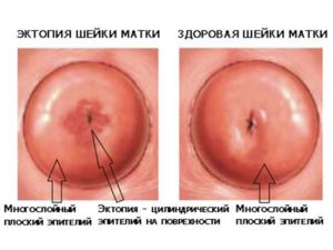 Мешает ли эрозия шейки матки забеременеть?