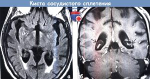 Двусторонние кисты хороидных сплетений боковых желудочков мозга