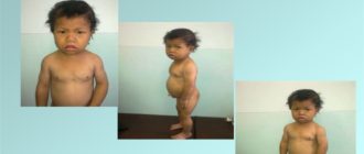 Врождённый гипотериоз