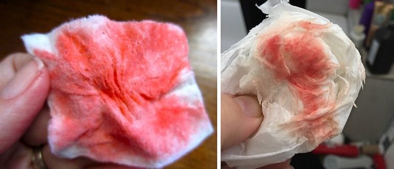 Через сутки после ППА есть кровянистые выделения. Почему такое возможно?