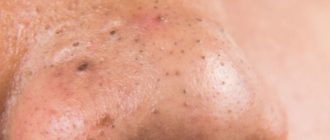 Черный прыщ на носу