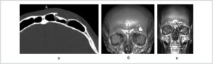 Восстановление после перелома передней стенки лобной пазухи