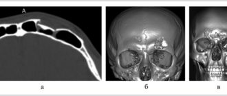 Восстановление после перелома передней стенки лобной пазухи