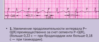 Эгилок и преходящая ав блокада 2 степени