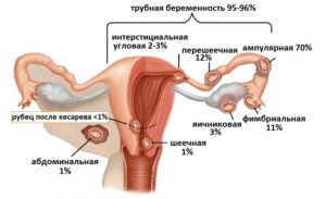 Возможность внематочной беременности