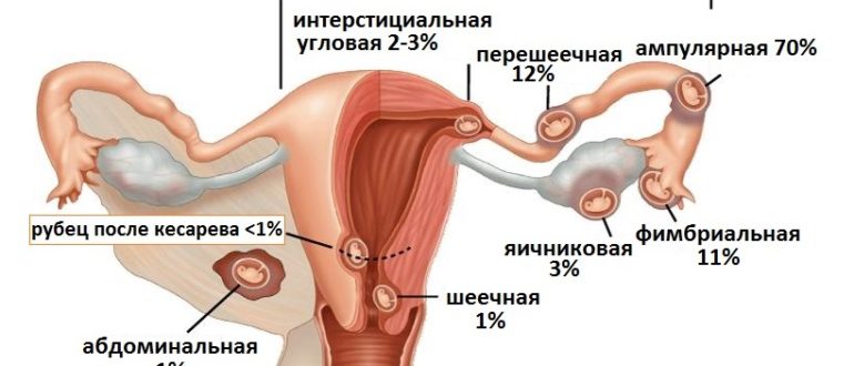 Возможность внематочной беременности