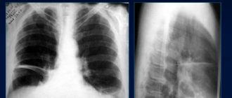 Дисковидный ателектаз над диафрагмой слева