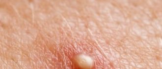 Волдыри на мошонке