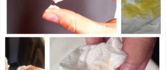 Выделения после использования свечей