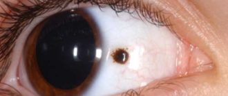 Черное пятно на глазном яблоке
